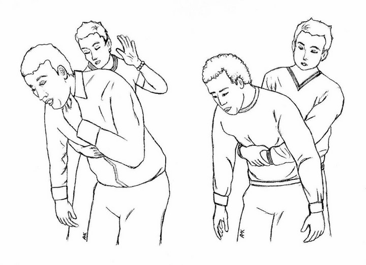 Cách thực hiện nghiệm pháp Heimlich Cách thực hiện nghiệm pháp Heimlich