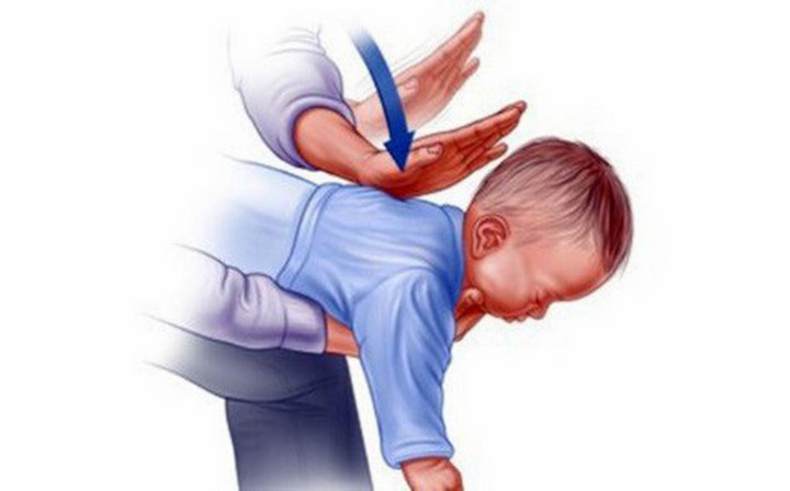 Cách thực hiện nghiệm pháp Heimlich cho sơ sinh dưới 1 tuổi Cách thực hiện nghiệm pháp Heimlich cho sơ sinh dưới 1 tuổi